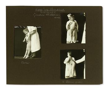 PEDIATRIC ORTHOPEDICS. Album of 84 silver print photographs of 21 patients before and after treatment. Germany, circa 1928-29